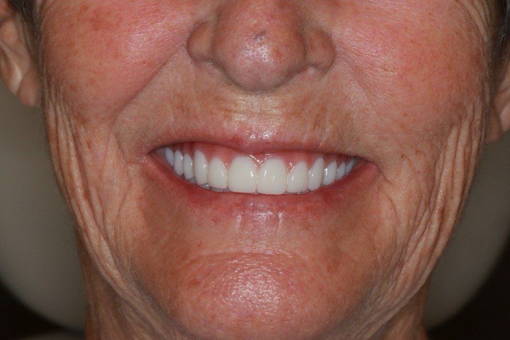 After treatment