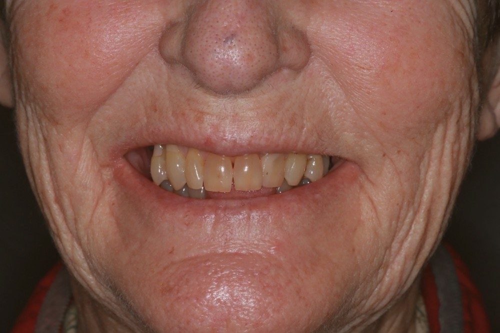Before treatment