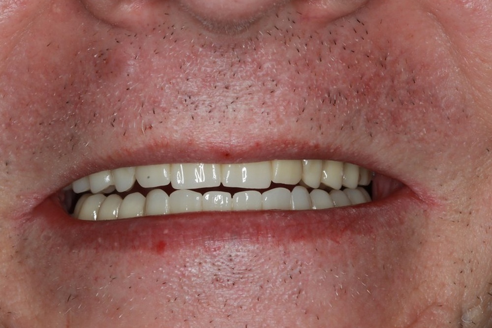 After treatment