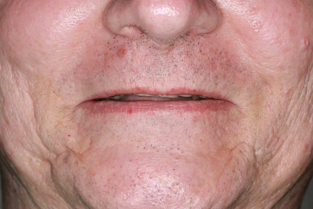 Before treatment