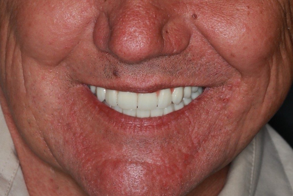 After treatment
