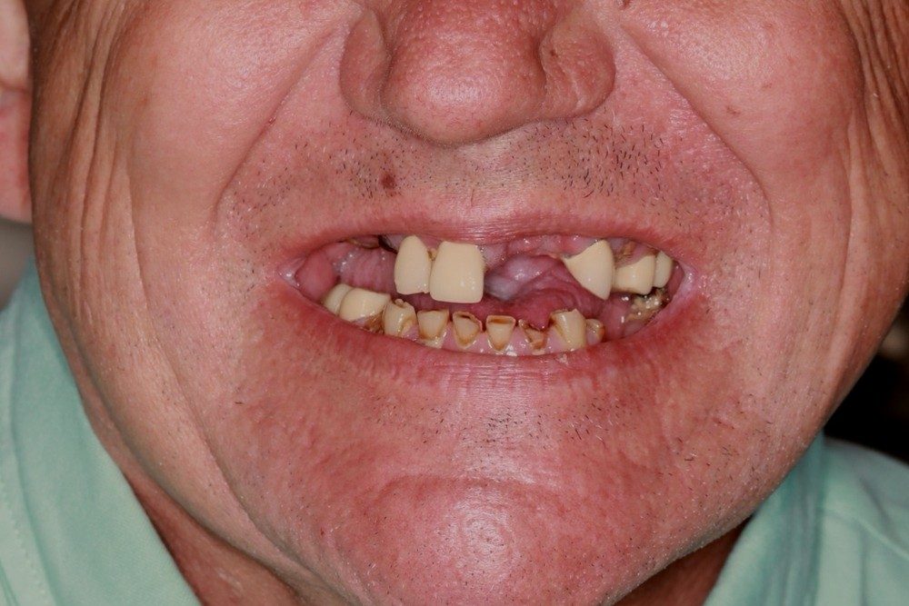 Before treatment