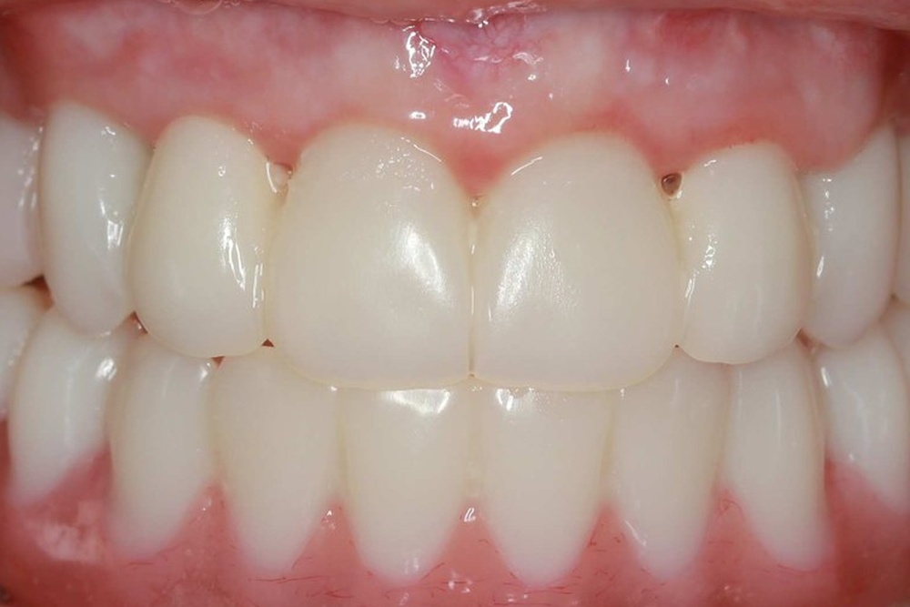 After treatment