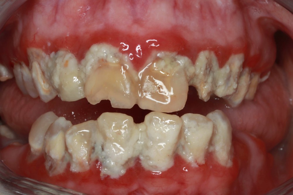 Before treatment